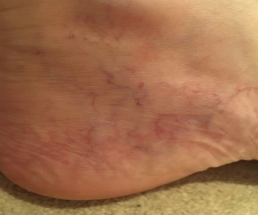 Corona phlebectatica on a persons ankle Corona phlebectatica on a persons ankle