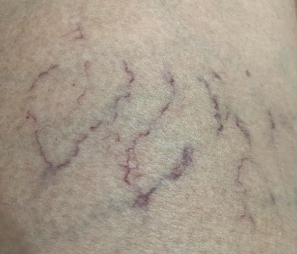 Telangiectasis Spider veins on a persons leg Telangiectasis Spider veins on a persons leg