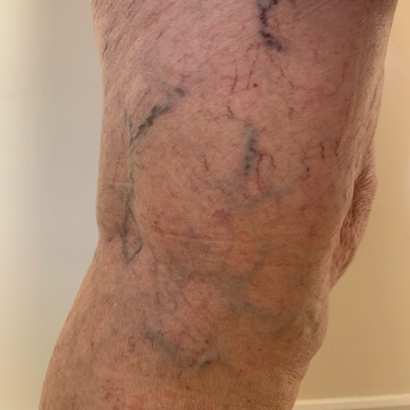 Varicose veins on a persons leg Varicose veins on a persons leg